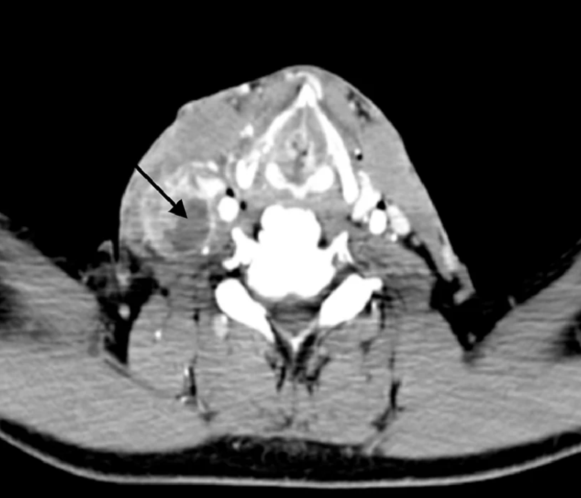 Coupe axiale de scanner cervical injecté montrant des adénopathies nécrotiques cervicales droites, à rehaussement périphérique, dans un contexte de tuberculose ganglionnaire