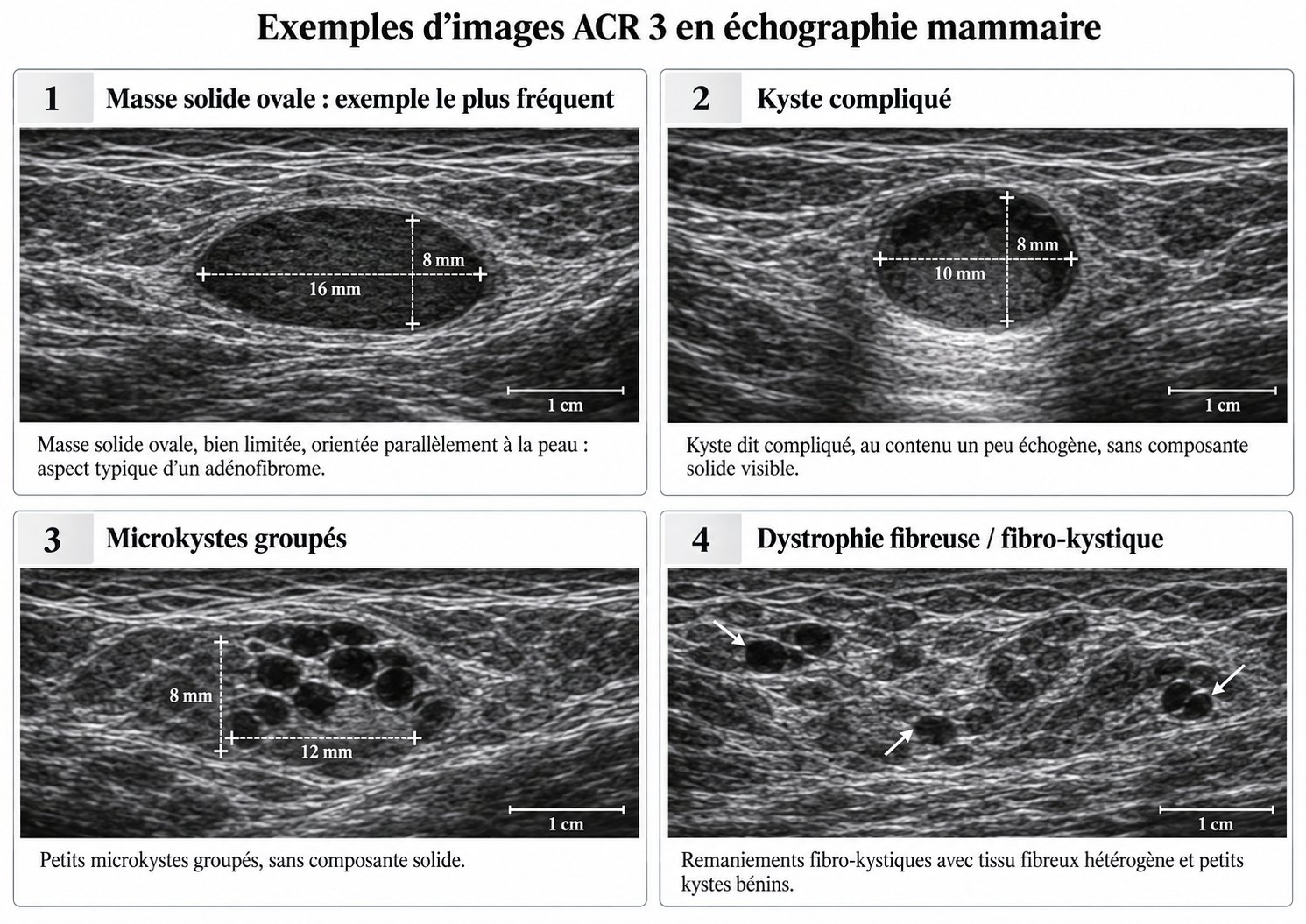 Exemples d'images ACR 3 en échographie mammaire : masse solide ovale parallèle à la peau, kyste compliqué au contenu un peu échogène, microkystes groupés sans composante solide, remaniements fibrokystiques avec petits kystes.