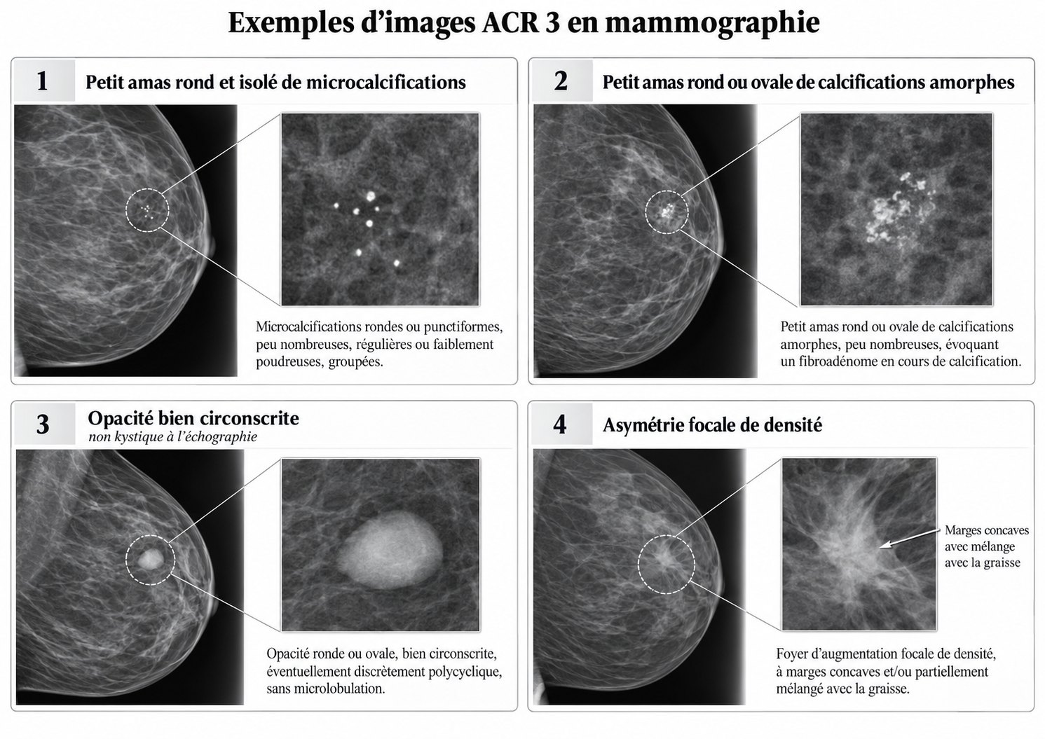 Exemples d'images ACR 3 en mammographie : petit amas rond et isolé de microcalcifications, petit amas rond ou ovale de calcifications amorphes, opacité bien circonscrite non kystique à l'échographie, asymétrie focale de densité à marges concaves mêlée de graisse.