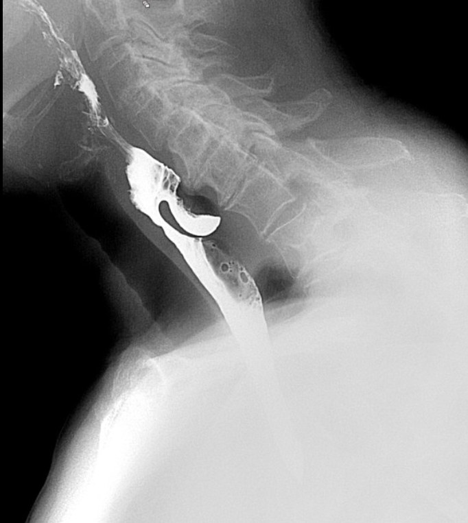 Radiographie du transit pharyngo-œsophagien avec produit de contraste montrant une poche de diverticule de Zenker