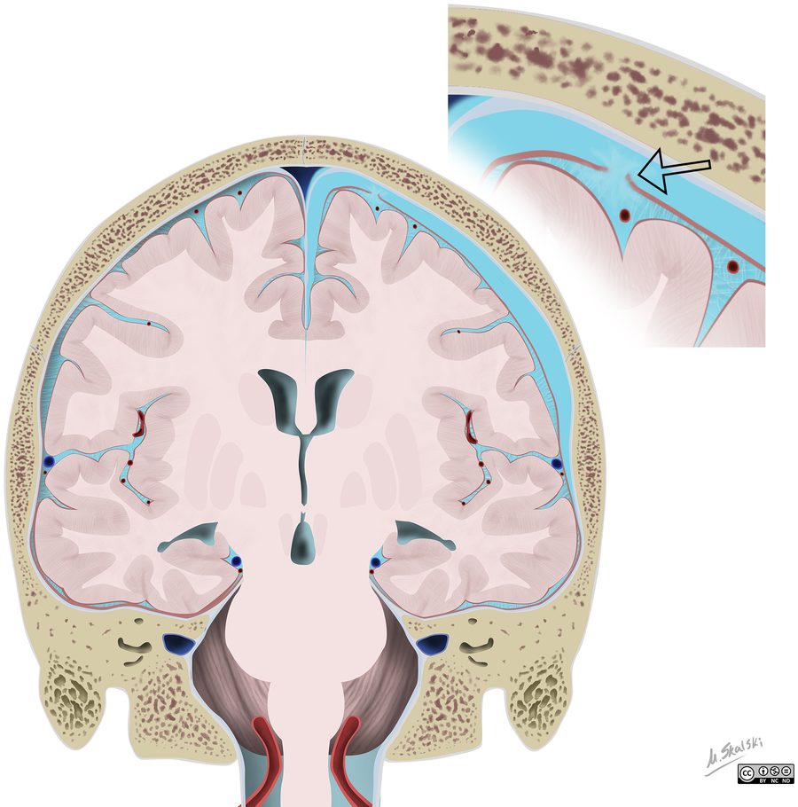 Illustration en coupe coronale d'un hygrome sous-dural, avec un encadré agrandi montrant la brèche de l'arachnoïde et une veine corticale traversant la collection