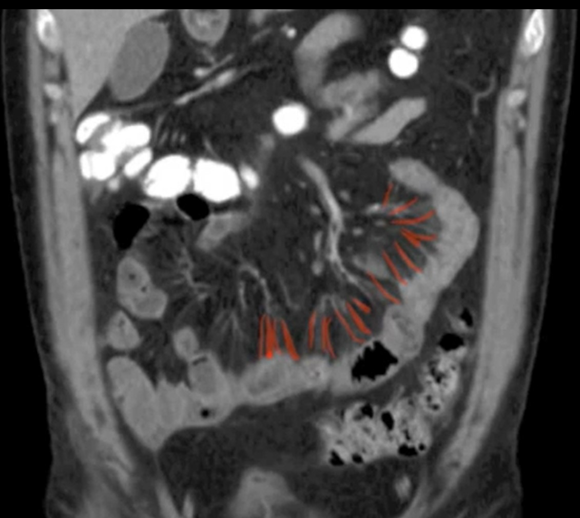 IRM coronale de l'abdomen montrant les vasa recta dilatés, surlignés en rouge, alignés comme les dents d'un peigne le long d'un segment iléal enflammé