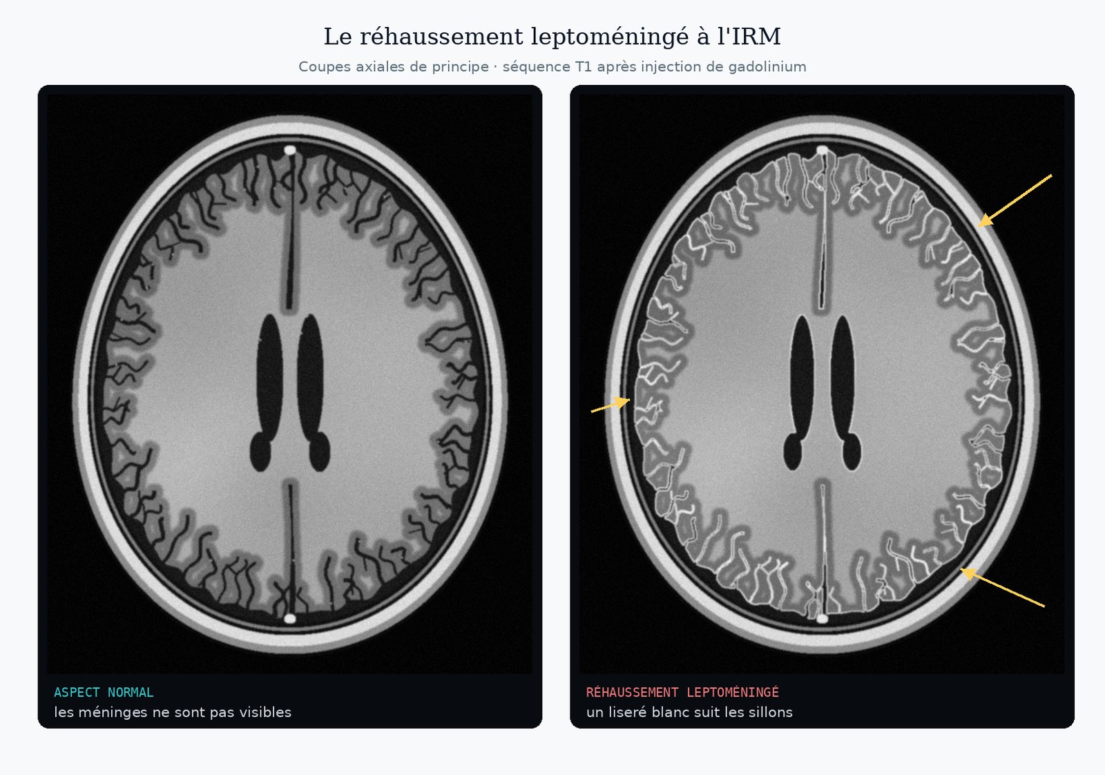 Deux coupes axiales d'IRM de principe en T1 après injection : à gauche, un aspect normal où les méninges ne sont pas visibles ; à droite, un réhaussement leptoméningé, liseré blanc qui borde la surface du cerveau et s'enfonce dans les sillons.